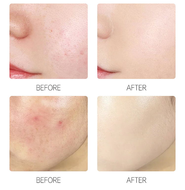 Adesivo para acne,Produtos OEM de Saúde e Bem-Estar | Fabricante de Soluções Personalizadas de Bem-Estar | Kongdy Health